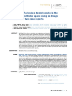 Removal of A Broken Dental Needle in The Pterygomandibular Space Using An Image Intensifier: Two Case Reports