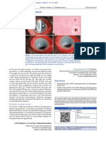 Corneal Melt in Leptospirosis