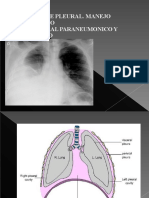 Derrame Pleural MIR