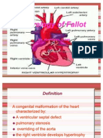 Tetralogy of Fallot