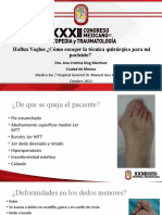 Hallux Valgus Escoger La Tecnica