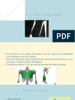 Fractura de La Diáfisis Humeral