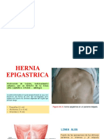 Hernia Epigastrica