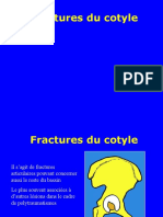 Fractures de Cotyle 2023