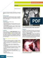 Endometriosis