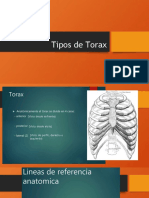 Tipos de Torax