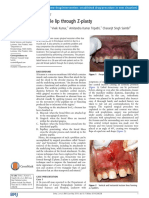 Frenectomy Z Plasty