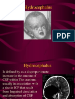 Hydrocephalus