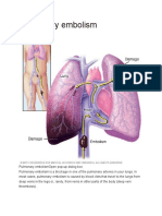 Pulmonary Embolism