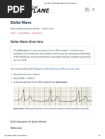 Delta Wave - LITFL Medical Blog - ECG Library Basics