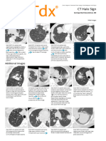 CT Halo Sign - Print Friendly - STATdx