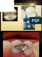Restaurações CL II