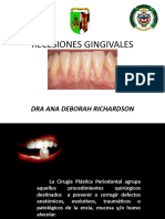 Recesiones Gingivales