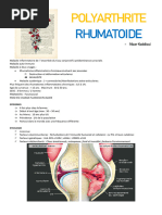 Polyarthrite Rhumatoïde