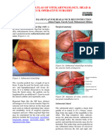 Submental Artery Island Flap Technique For Head Neck Reconstruction