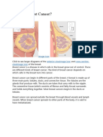 Types of Breast Cancer