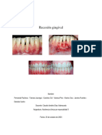 Recesión Gingival