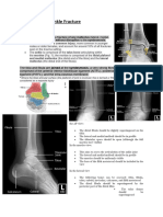 Ankle Fracture