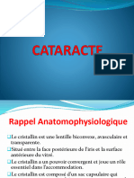 Cataract e