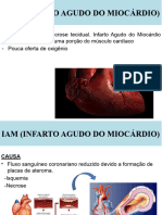 Infarto Agudo Do Miocárdio - Aula