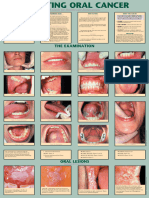 Oral Cancer Poster