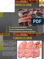 Tuberculosis