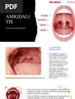 AMIGDALITIS 