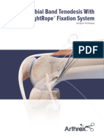 Iliotibial Band Tenodesis With Tightrope Fixation System