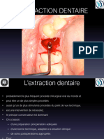 4-5. L'Extraction Dentaire