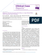 Malignant Pheochromocytoma Presenting As A Large Adrena - 2024 - AACE Clinical C