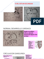 DEFECTO DEL OSTIUM SECUNDUM y PRIMUM