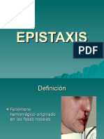 Epistaxis