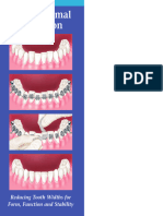 Interproximal Reduction