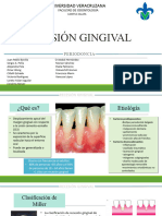 Recesión Gingival Clase Perio