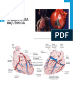 Cardiopatía Isquémica