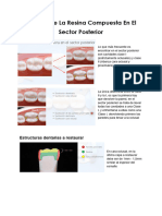 Manejo de Resina Compuesta en Sector Posterior