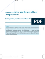 Above Elbow and Below Elbow Amputation