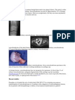 Osteochondroma Is The Most Common Benign Bone Tumor