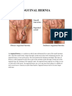 Inguinal Hernia