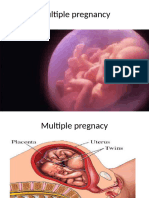 Multiple Pregnancy