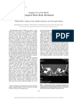 Temporal Bone Brain Herniation: Imaging Case of The Month