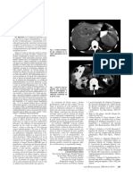 Archbronmconeumol2008 Empiemapleural