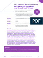 Hansens Disease With Pure Nerve Involvement and Perineural Abscess Mistaken For Peripheral Nerve Sheath Tumour