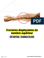 Fractures diaphysaires du membre supérieur