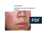 Acute cutaneous lupus erythematosus