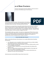 Different Types of Bone Fractures