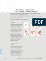 Mainz II Surgery Illustrated