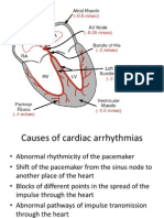 Arrhythmia