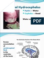 Congenital Hydrocephalus