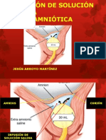 Infusión de Sol Salina Extraamniótica